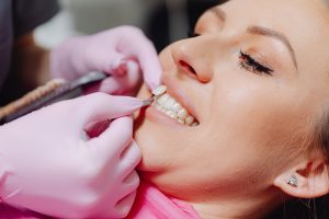 What you need to know about dentalveneers