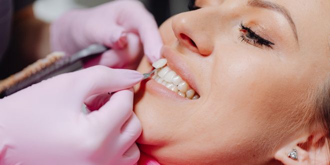 What you need to know about dentalveneers