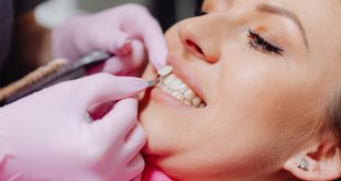 What you need to know about dentalveneers